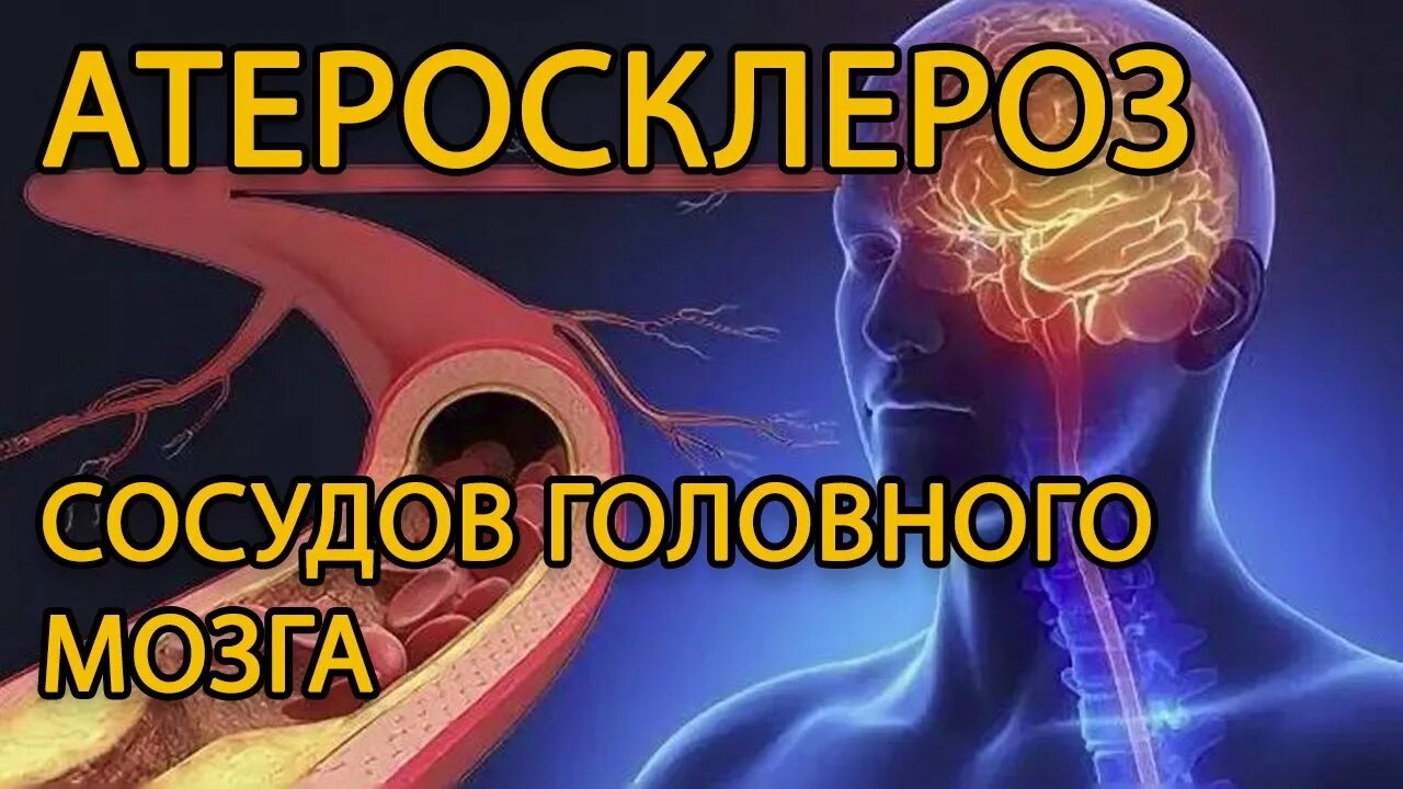 Атеросклероз сосудов головного мозга. Атеросклероз сосудов головы. Атеросклероз артерий мозга. Бляшки в сосудах головного мозга. Лечение церебрального атеросклероза сосудов головного