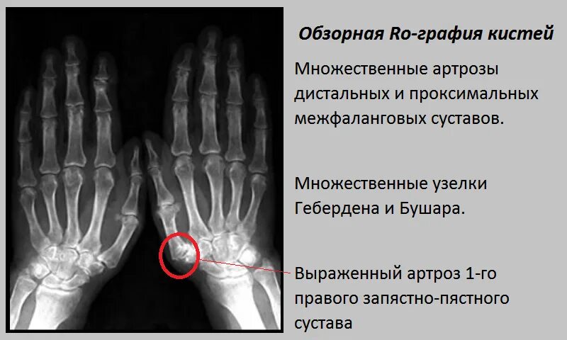 Первый запястно пястный сустав. Подвывих 1 пястной кости на рентгене. запястно-пястный сустав 1 пальца кисти. подвывих первого пястно запястного сустава рентген. артроз пястно-запястного сустава на рентгене.
