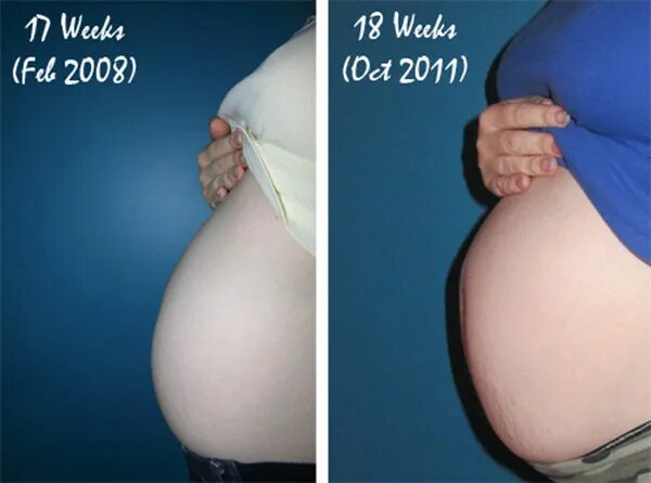17 2 недели беременности. Живот на 18 неделе беременности. 17-18 Недель беременности фото живота. Животик на 18 неделе беременности.