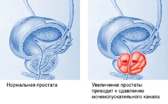 Виды простатита. Простата нормальная и воспаленная. Увеличенная предстательная железа.