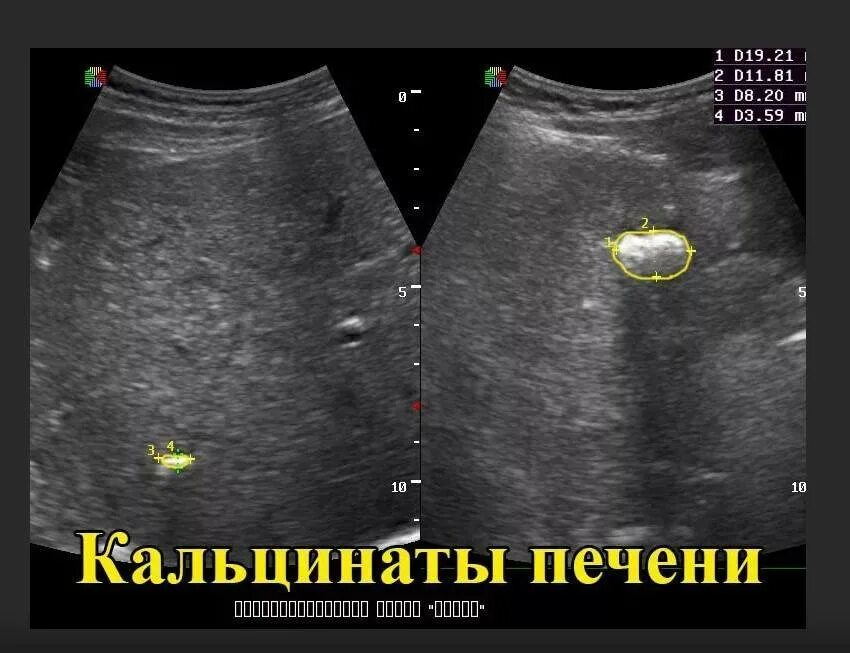 Кальцинат в правой доле. УЗИ признаки кальцинатов печени. Микрокальцинаты в печени на УЗИ. Кальцинаты в паренхиме печени.