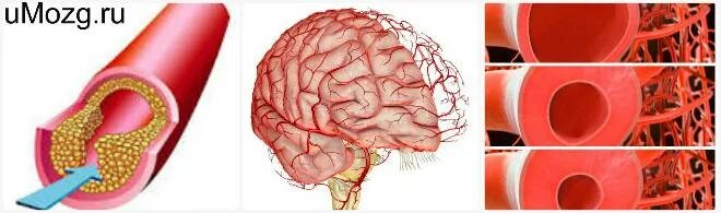 Гипертонус сосудов головного мозга. Сужение и расширение сосудов. Тонус сосудов головного.