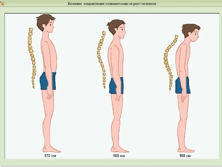 Как замедлить рост. Рост позвоночника. Влияние роста на позвоночник. Влияет ли искривление позвоночника на рост. Рост позвоночника у детей.