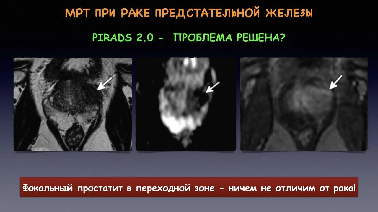 Предстательная железа pirads. Pirads мрт. Карцинома мрт предстательной железы.