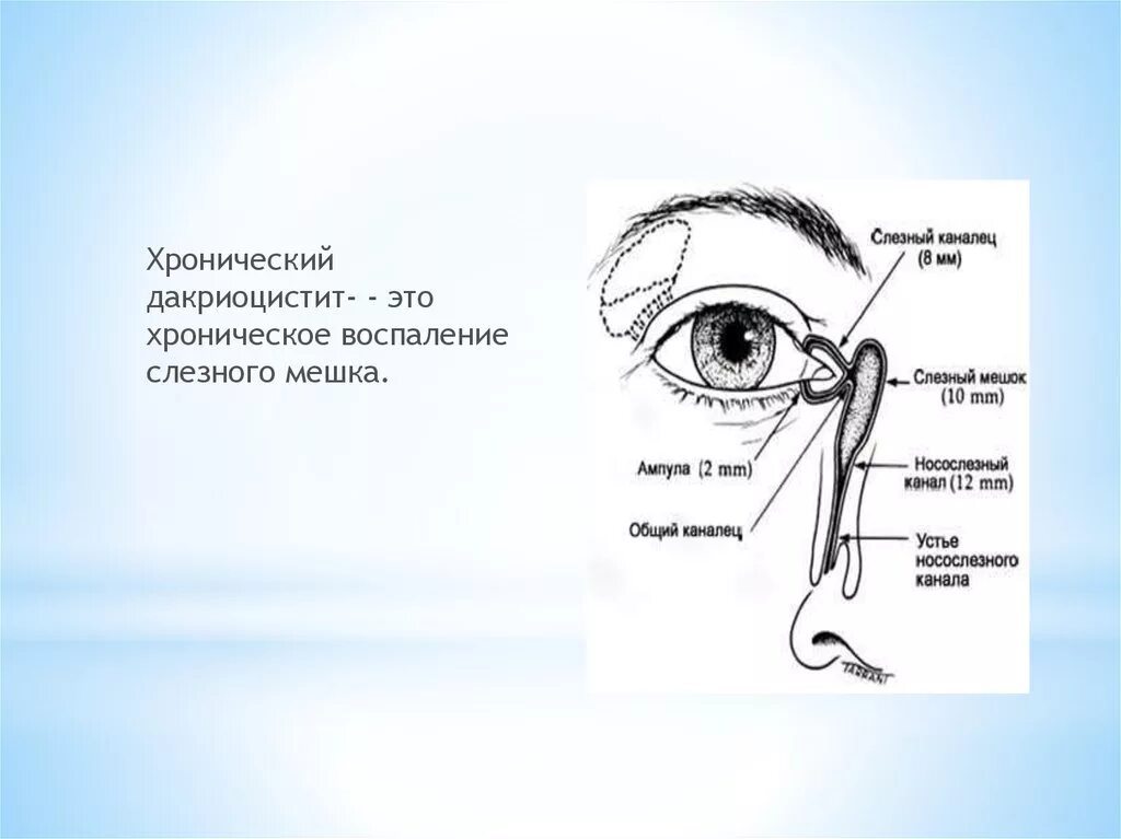 Носослезный канал открывается. Слезная точка дакриоцистит. Носослезный мешок воспаление. Воспаление слюнного мешочка.