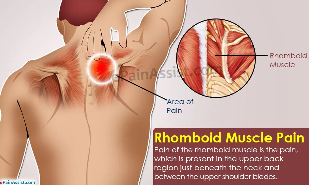 Rhomboid muscle. Rhomboid Pain. Ромбовидная боль. Back between