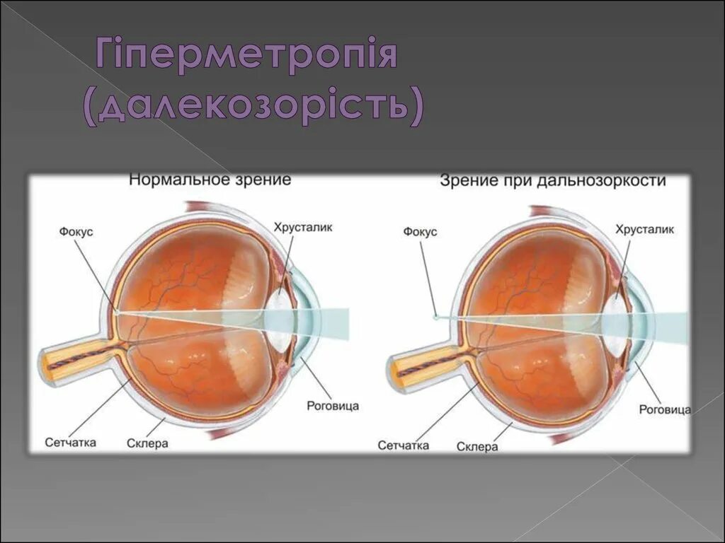 Дальнозоркость форум. Дальнозоркость. очки при дальнозоркости линзы. миопия. дальнозоркость глаз.