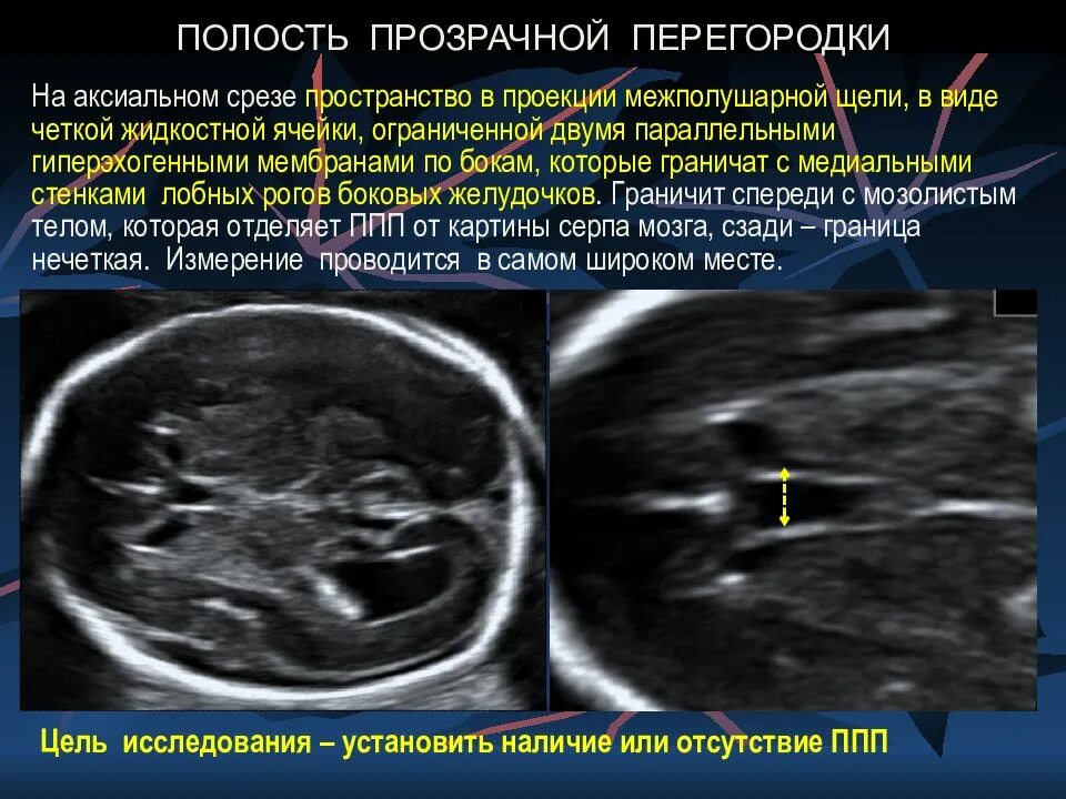 Мозг у плода норма. Полость прозрачной перегородки на УЗИ норма. Расширение полости прозрачной перегородки на УЗИ. Нейросонография полость прозрачной перегородки. Отсутствие визуализации полости прозрачной перегородки.