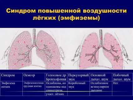 Эмфизема плевры