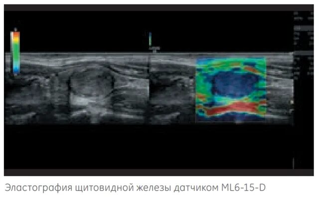 Эластография щитовидной железы что это. Ультразвуковая компрессионная эластография. Эластография Logiq. Компрессионная эластография щитовидной железы. УЗИ эластография.