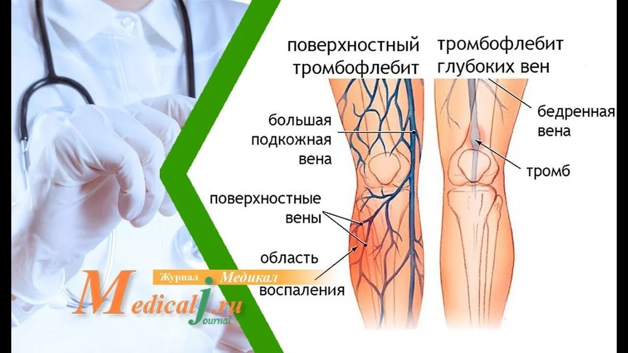 Послеоперационный тромбоз. Тромбофлебит поверхностных вен нижних конечностей. Тромбофлебит клинические проявления. Флебит и тромбофлебит нижних конечностей. Тромбоз поверхностных вен.