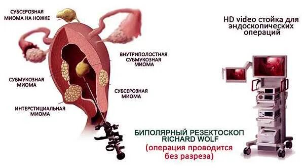Можно ли удалить миому матки. Миома матки субмукозный рождающийся узел. миома матки факторы риска. интрамурально субмукозная миома матки. миома субмукозная и субсерозная.
