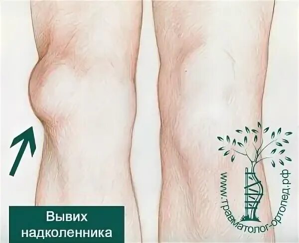 Типы надколенника. Типы надколенника