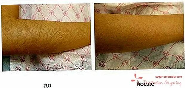 удалять ли волосы на руках