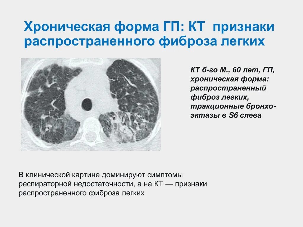 Интерстициальные заболевания легких кт. Фиброз лёгких на кт. Пневмофиброз на кт легких. Что означает изменения в легких