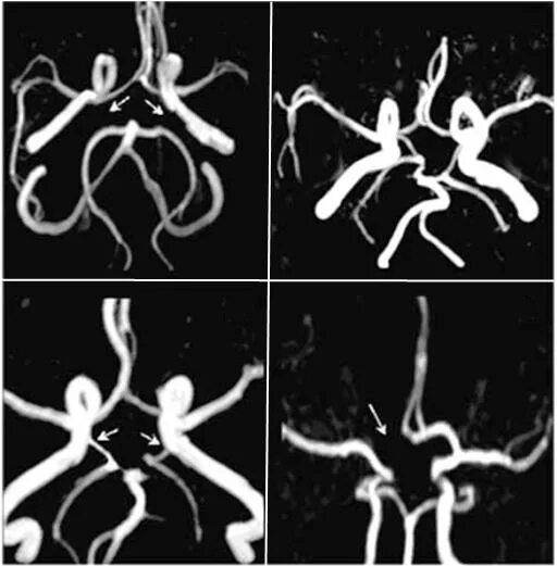 Виллизиев круг мрт. Сосуды головы Виллизиев круг. Замкнутый Виллизиев круг на мрт. Аномалия сосудов Виллизиева круга.