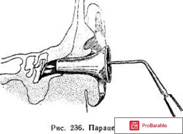 Пункция барабанной перепонки. Парацентез барабанной перепонки. Парацентез (прокол) барабанной перепонки при отите. Прокол барабанной перепонки при отите. Парацентез барабанной перепонки это