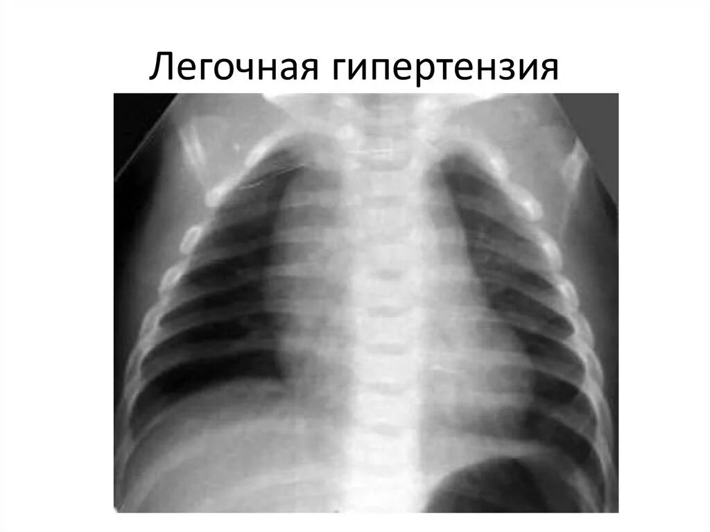 Легочная гипертензия у новорожденного. Легочная гипертензия у детей рентген. Рентген при легочной гипертензии. Рентгенограмма при легочной гипертензии. Легочная гипертензия рентген признаки.