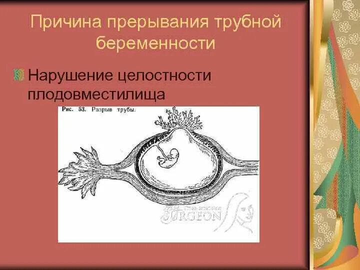 Варианты прерывания трубной беременности. Наружный разрыв плодовместилища. Варианты нарушения трубной беременности. Нарушенная Трубная беременность.