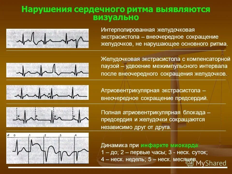 ЭКГ – выявление признаков нарушений ритма. Нарушение ритма сердца на ЭКГ. Нарушение ритмасеодца. Виды аритмий на ЭКГ.