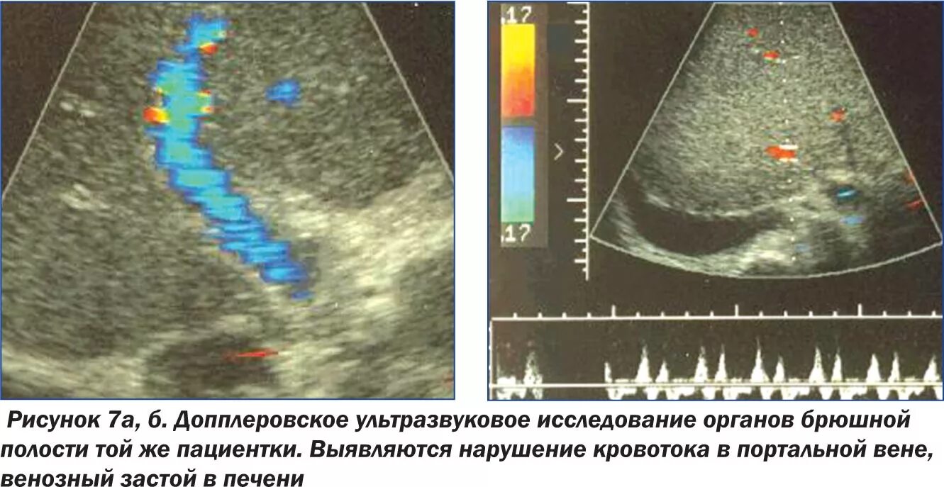 Расширение воротной вены. Синдром Бадда Киари доплер. Портальная гипертензия Бадда-Киари.