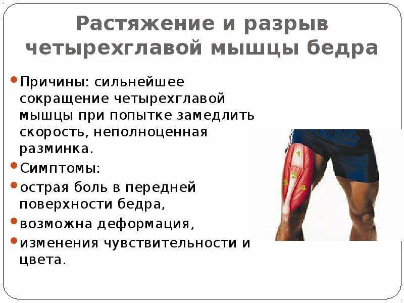 При растяжении мышц необходимо. Разрыв четырехглавой мышцы бедра. растяжение четырехглавой мышцы бедра. отрыв четырехглавой мышцы.