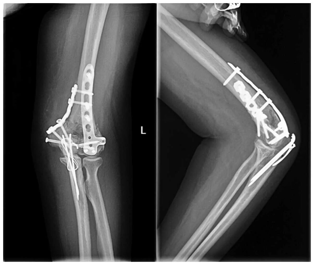 Fracture c