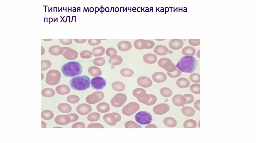 Тени Боткина Гумпрехта. Клетки Боткина Гумпрехта это. Острый лимфобластный лейкоз мазок. Хронический лимфолейкоз картина периферической крови. Хронический лимфолейкоз кровь