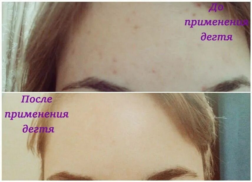 Мыть лицо дегтярным мылом от прыщей. Дегтярное мыло от прыщей. берёзовый дёготь от прыщей на лице. берёзовыйдёготь от пришей.
