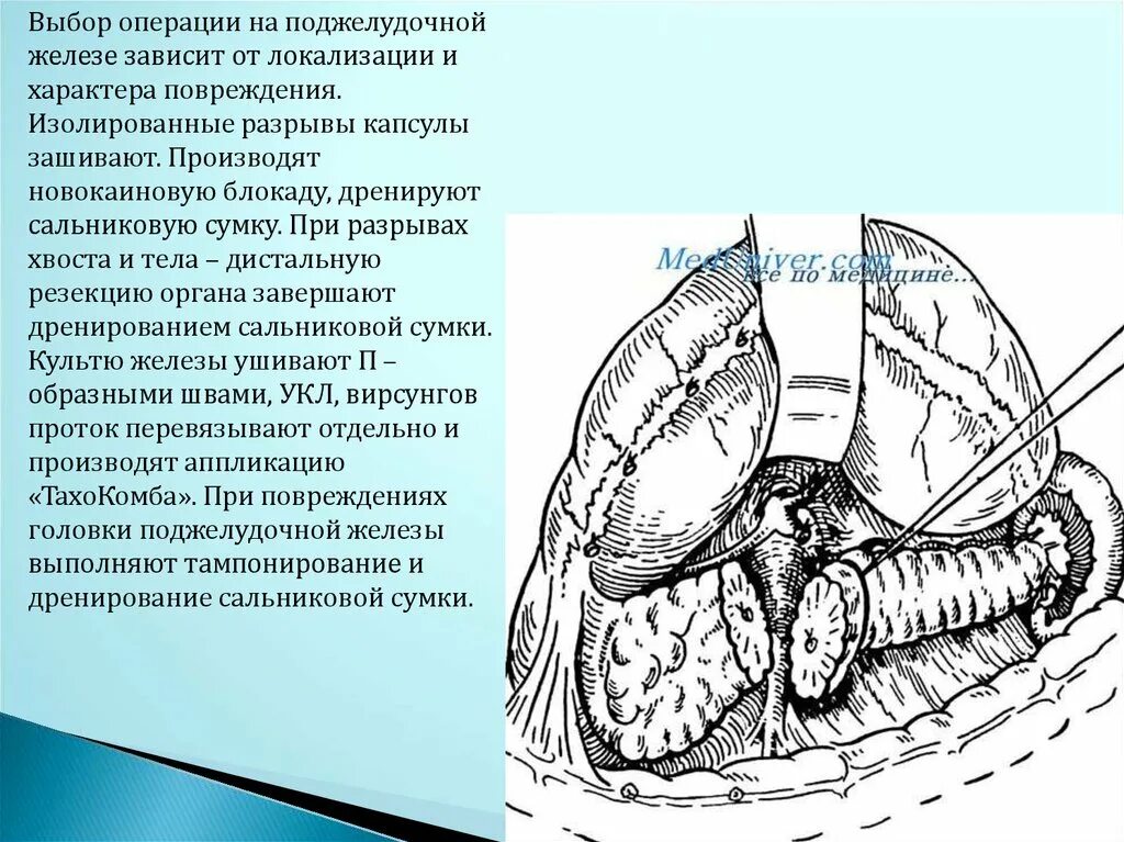 Поджелудочная железа операция отзывы. Операции на поджелудочной железе. Хирургические операции на поджелудочной железе. Резекция хвоста поджелудочной железы. Травма поджелудочной железы.