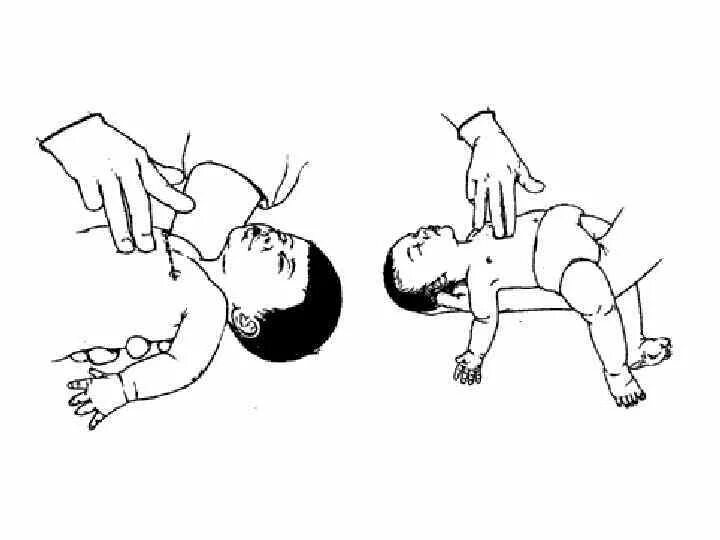 Сердечно легочная реанимация ребенку до года. Сердечно-легочная реанимация ребенок 1 год. Сердечно-лёгочная реанимация у детей до 1 года. ИВЛ И непрямой массаж сердца алгоритм детям.
