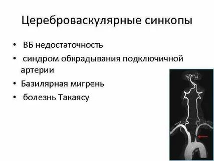 Обкрадывания подключичной артерии