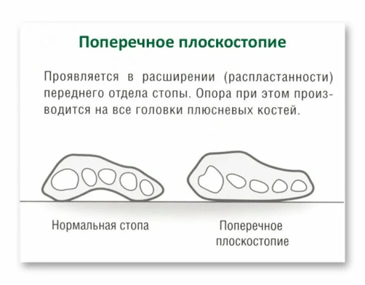 Продольное и поперечное плоскостопие степени. Поперечное плоскостопие схема. Плоскостопие 3 степени градусы. Поперечно продольное плоскостопие 3 степени. Поперечное плоскостопие 3 ст.