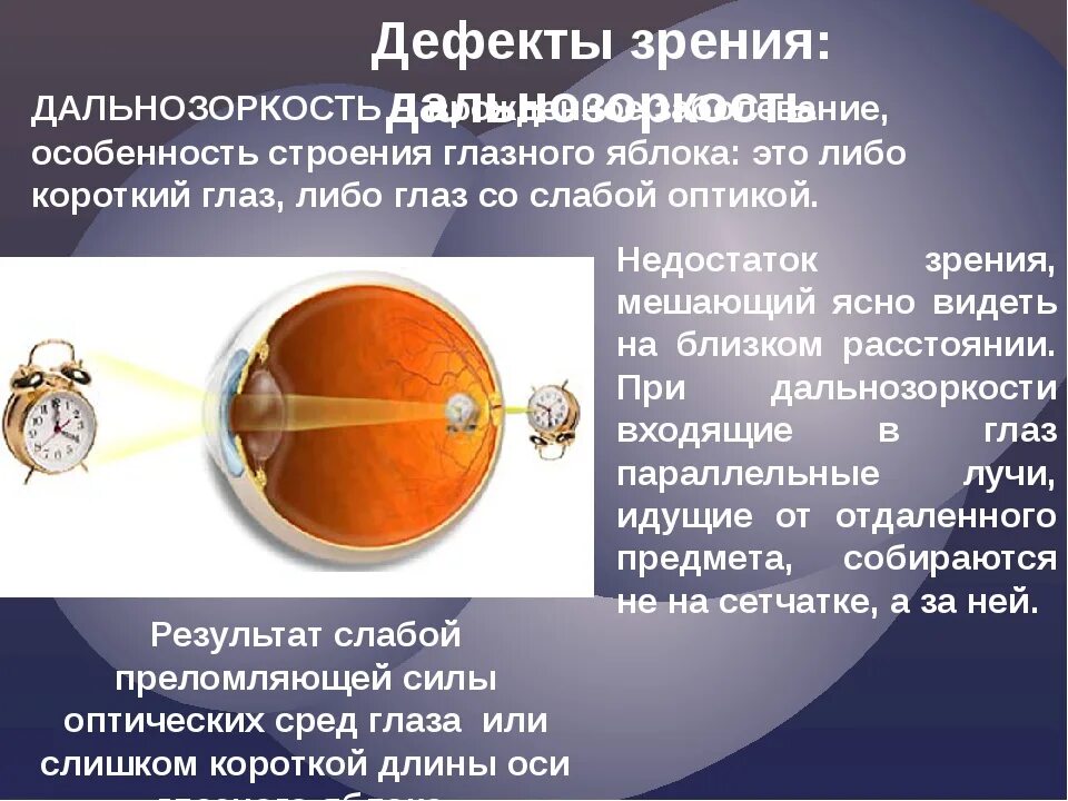 Дефекты зрения ответы. Дефекты зрения. Дефекты зрения физика. Дефекты зрения дальнозоркость. Глазные дефекты зрения.