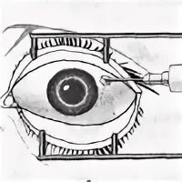 Интравитреальная инъекция. Интравитреальное Введение в глаз. Инъекция в стекловидное тело. Интравитреальные инъекции в глаз.