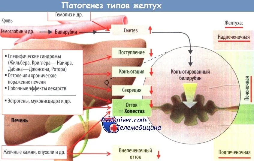 Печеночная желтуха билирубин. Печеночная желтуха билирубин