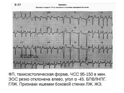Тахисистолическая предсердие