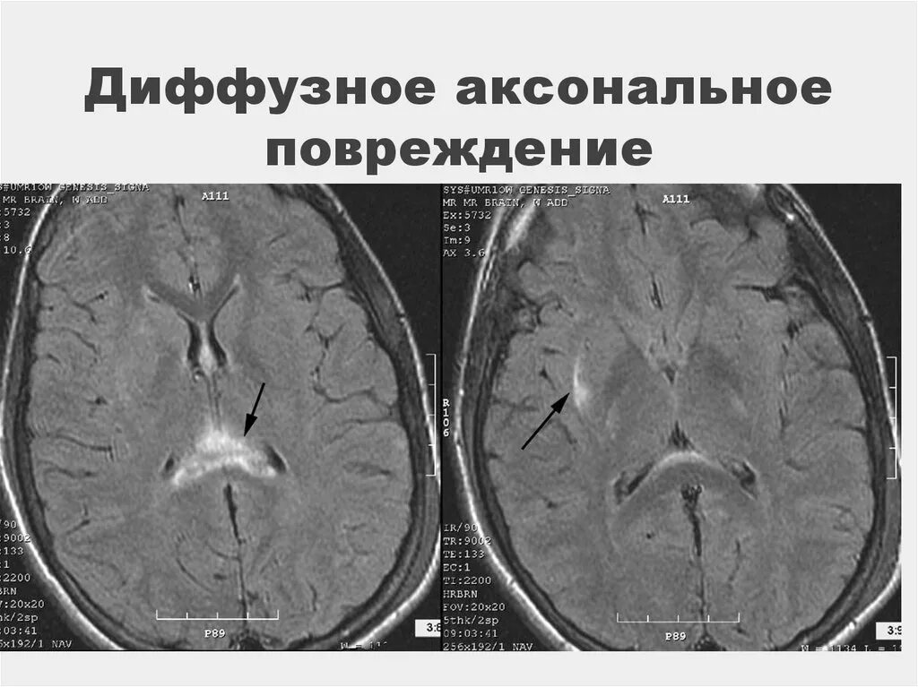 Диффузные нарушения мозга. Диффузное аксональное поражение головного мозга. Диффузно аксональные повреждения головного мозга кт. Диффузное аксональное повреждение ДАП головного мозга. Диффузное аксональное повреждение головного мозга ЧМТ.