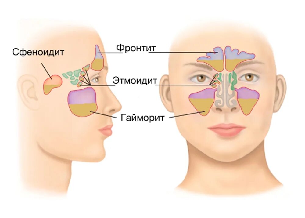 Верхнечелюстные пазухи где находятся. Билатерального гайморита,. Гайморовы пазухи гайморит. Острый гнойный верхнечелюстной синусит диагностика. Причины болезни гайморита у детей.