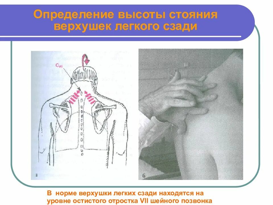 Высота стояния верхушки легкого сзади. Определение высоты стояния верхушек. Определение верхушки легкого сзади. Высота стояния верхушек легких. Высота стояния верхушки легкого сзади.