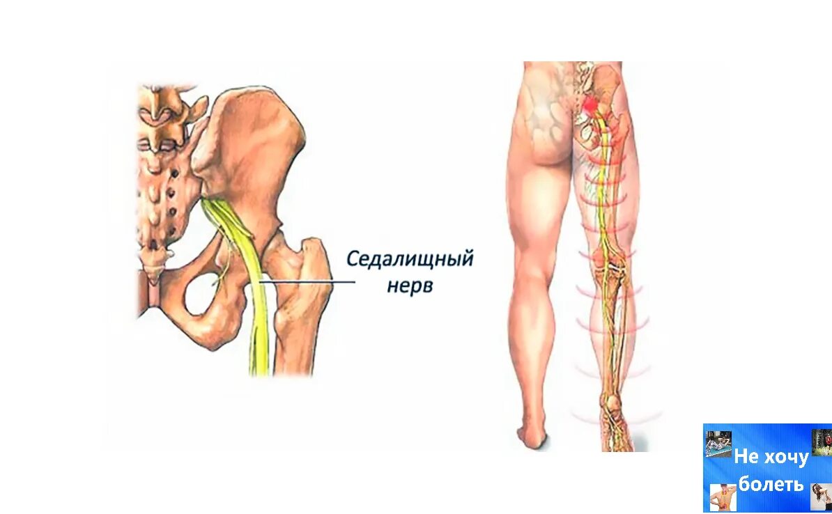 Можно делать массаж при седалищном