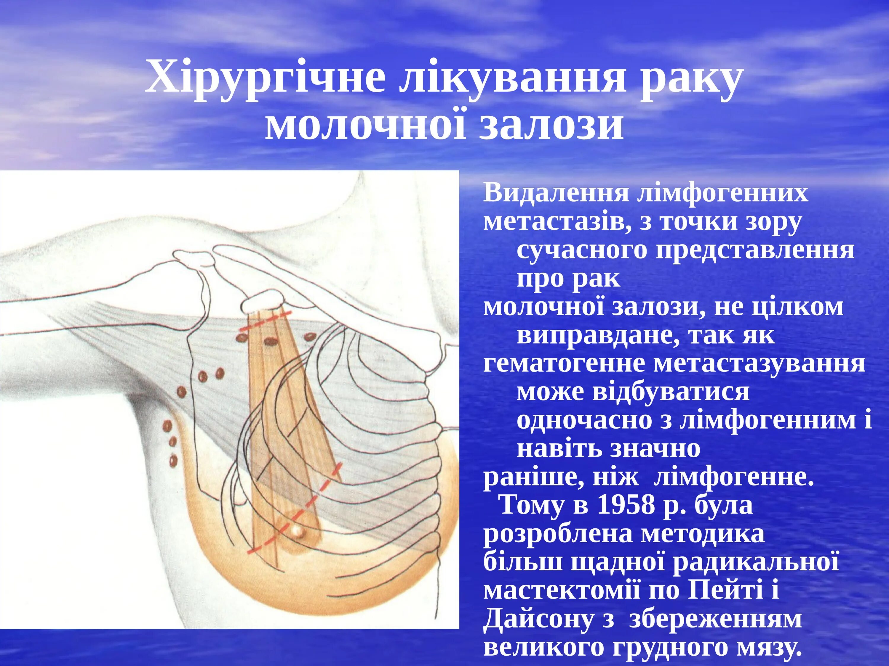 Рак молочной железы исцеление. Молочной железы. Радикальная мастэктомия. Онкология молочной железы. Молочная железа презентация.