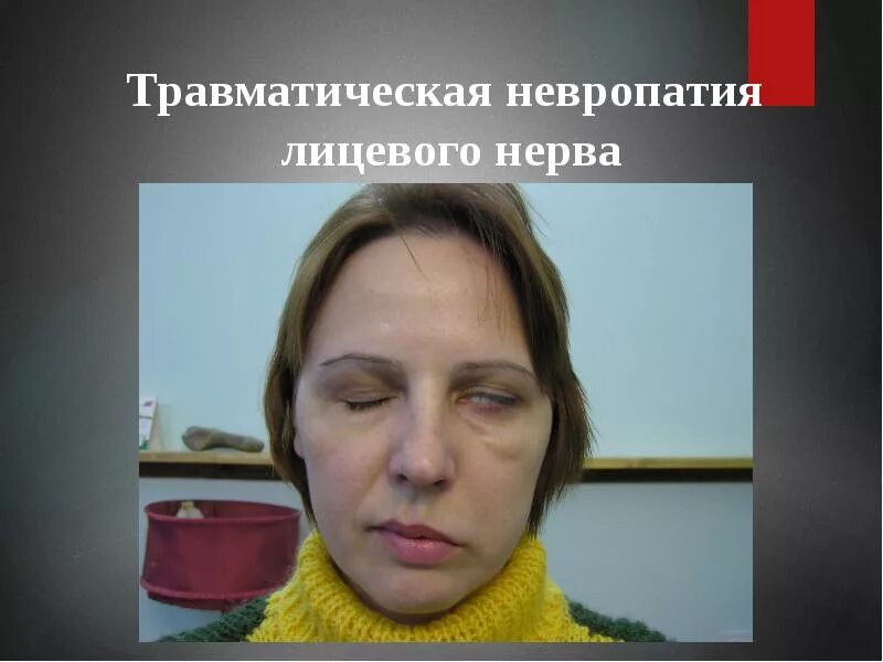 Воспаление тройничного лицевого нерва симптомы. Невропатия лицевого нерва. неврит лицевого лицевого нерва. неврит правого лицевого нерва. осложнения неврита лицевого нерва.