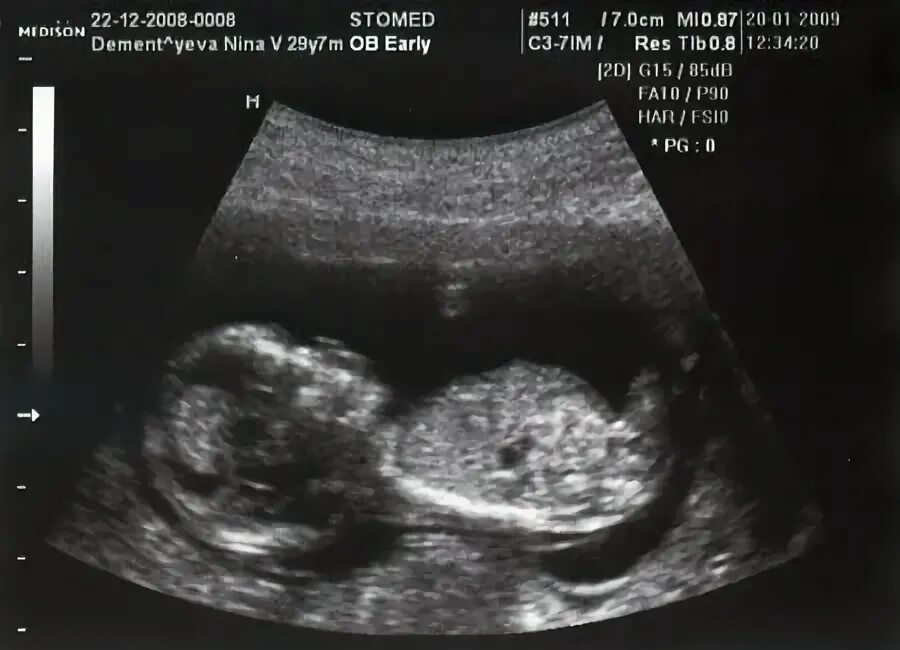 Малыш на 14 неделе. УЗИ 14 недель беременности. Размер зародыша 14 недель ?. Фото УЗИ 13-14 недель беременности. 14 Недель беременности фото плода на УЗИ.