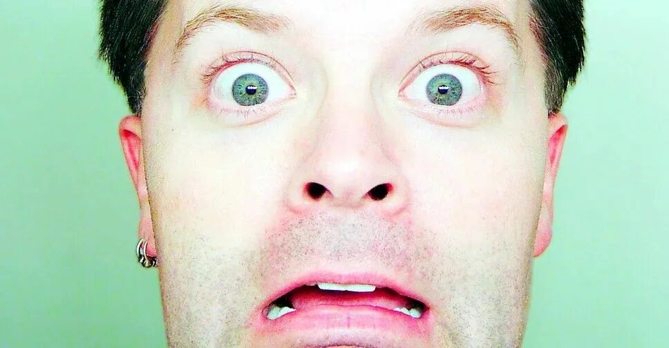 Удивленные глаза девушки. Герпетический кератоконъюнктивит. Парень свыпучеными глазами. Мидриаз, экзофтальм птоз. Глаза стали удивленными.