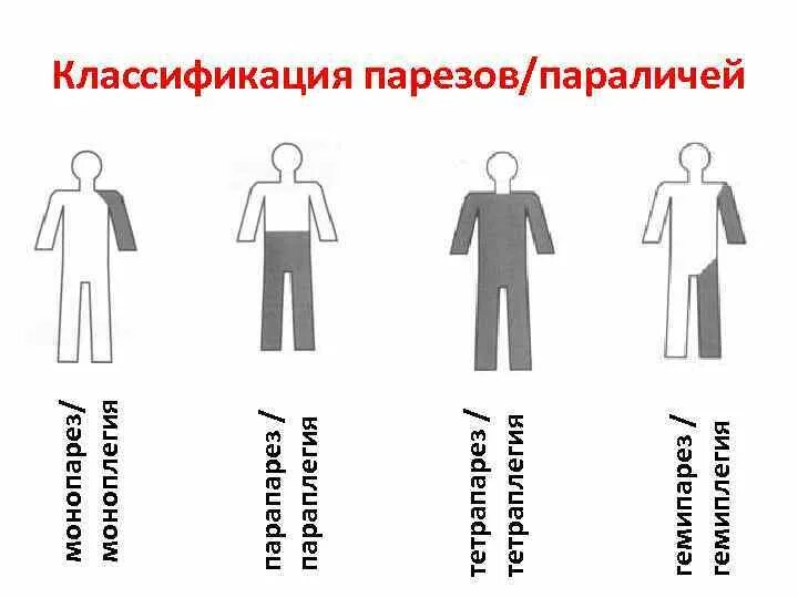 Парезы классификация неврология. Классификация параличей. Классификация парезов и параличей. Монопарез гемипарез парапарез тетрапарез. Инсульт левосторонний гемипарез