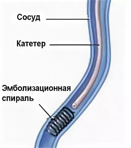 Спираль в сосуде