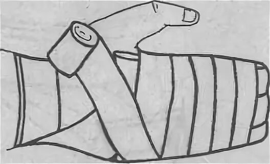 Техника наложения варежки. Десмургия повязка варежка. Перевязка варежка алгоритм. Техника наложения повязки варежка алгоритм. Наложение повязки на кисть варежка.