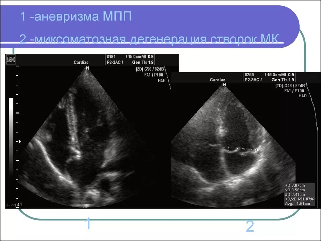 Аневризма перегородки у ребенка. Аневризма МПП на ЭХОКГ. Типы аневризм МПП на ЭХОКГ. Дефект межпредсердной перегородки ЭХОКГ. R Тип аневризмы межпредсердной перегородки.