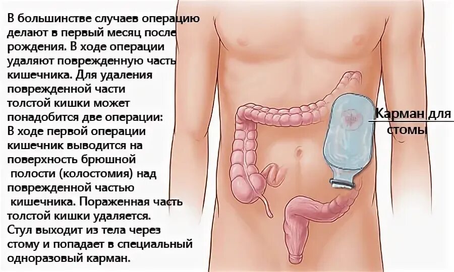 Операции при болезни Гиршпрунга у детей.. Колостома Толстого кишечника. Стома сигмовидной кишки.